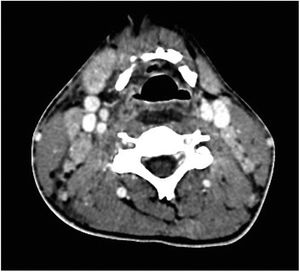 Bilateral reactive lymph node enlargement in sides of the neck.