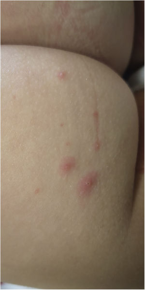 Detail of cutaneous lesions in Fig. 1.