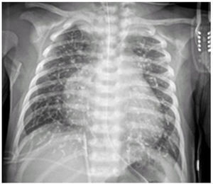 Cardiomegaly, air trapping and opacity of pulmonary vessels without parenchymal involvement. Visualization of the orogastric tube and femoral catheter inserted in the patient.