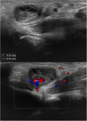 A. Inguinal ultrasound. A hypoechoic mass measuring 9 × 14 mm with millimetric hypoechoic foci inside is identified within the hernial sac. B. Doppler ultrasound scan of the lesion which rules out vascular involvement.