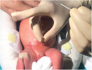 Puncture in hypogastrium. Passage of the guide wire after removal of the angiocatheter needle.