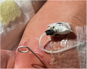 Double-J stent in the hypogastrium with clear urine drainage.