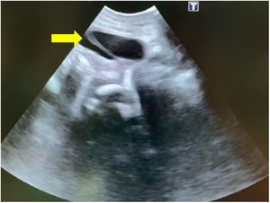 Verification of correct placement of the double-J stent at the vesical level (yellow arrow).