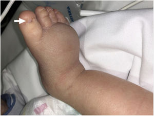 Hard, cold and symmetrical oedema in legs and dorsum of feet with thickening of the dermis and ungual dysplasia (arrow).