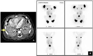 (A) Computed tomography evincing bilateral partial pulmonary hypoplasia, more marked on the right side (arrow). (B) Lymphoscintigraphy with visualization of axillary lymph nodes but not of popliteal and inguinal nodes, compatible with congenital lymphatic aplasia.