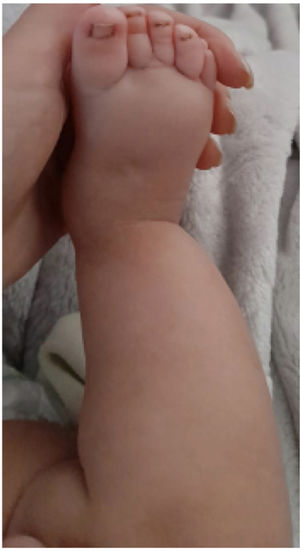 Progressive reduction of lymphoedema after 6 months of compression and physical therapy.