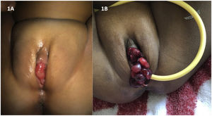 Image A shows a polypoid lesion of 2 weeks’ duration. Image B shows the same mass 2 months later. Mass characterised by multiple dark red polypoid-tuberous lesions with a grape cluster appearance occupying the vulvar mucosa and protruding through the introitus.