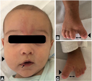 A) Capillary malformation between the brows and in the lower lip (arrow) with right facial asymmetry (arrowhead). Overgrowth of the first toe of the feet (arrowhead) with bilateral sandal gap (double-headed arrow): B) right foot, C) left foot. Phenotype compatible with CLAPO syndrome.