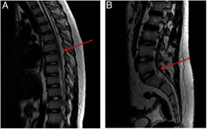 Magnetic resonance of the spine evincing an increase in epidural fat (spinal epidural lipomatosis) resulting in stenosis of the spinal canal at the dorsal (1A) and lumbar (1B) levels. The mass effect was most severe in the L4-S1 segment (1B) and possibly compounded by congenital lumbar canal stenosis.
