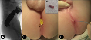 (A) Colostogram showing the rectal pouch without any fistulas, probably due to insufficient pressure during its performance. (B) Resected finger-shaped skin appendage (*) and appearance of a drop of liquid under its original location after distal stoma irrigation (arrow). (C) Pore intubated with a dilation balloon catheter.
