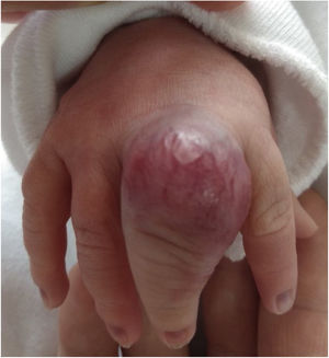 Involution of congenital hemangioma at birth.