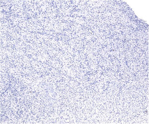 Histology: Negative GLUT-1 stain.