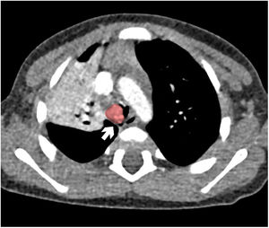 Computed tomography. Near complete obstruction of the tracheal lumen by a solid enhancing lesion (white arrow). To facilitate the interpretation of the image, the volume that corresponds to the AIH has been highlighted in red. Pattern of consolidation-atelectasis in most of the right upper lobe with air bronchogram causing mild ipsilateral tracheal displacement.