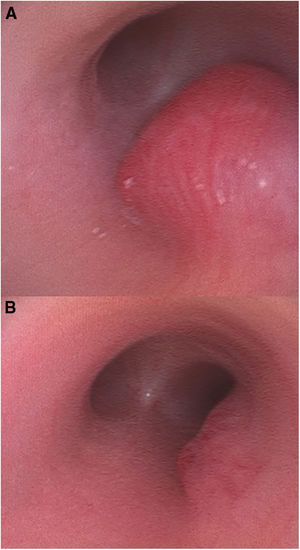 Bronchoscopy images of the lesion. A: at diagnosis. B: after 5 months of treatment with oral propranolol. Note the marked decrease in size of the lesion.