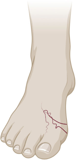 Illustration of the creeping and tortuous lesion characteristic of cutaneous larva migrans.