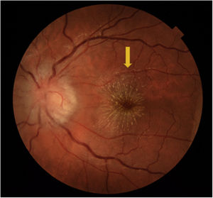Optic disc oedema and exudates around the macula (macular star) in the left eye 1 week after diagnosis (arrow).