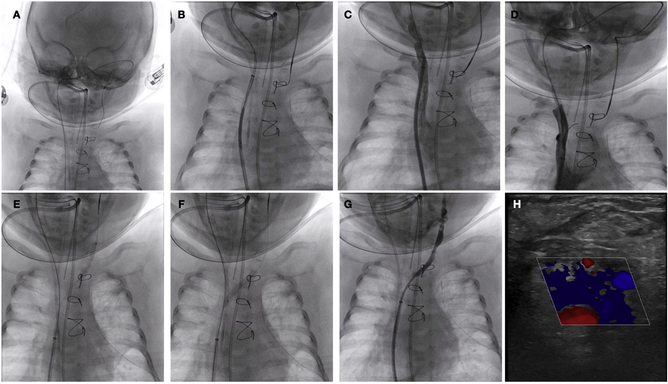 Pps Surgery Percutaneous solution of post-cardiac surgery complications | Anales de ...