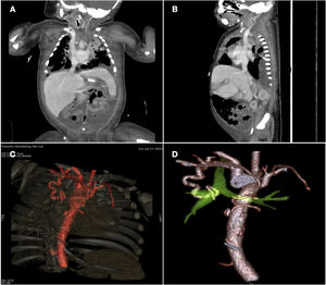 Computed tomography images. (A and B). Thrombosis of the left jugular-subclavian system. (C and D) Aberrant right bronchial artery originating from the right subclavian artery.