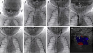 (A–C) Advance of the angioplasty guide wire and microcatheter from the right internal jugular vein through the intracranial venous system to the left jugular vein. (D) Crossing through the innominate vein to establish the veno-venous shunt. (E and F) Progressive balloon predilatation. (G) Final result with patency of the left jugular-subclavian venous system. (H) Follow-up Doppler ultrasound examination before discharge confirming the persistence of luminal patency.