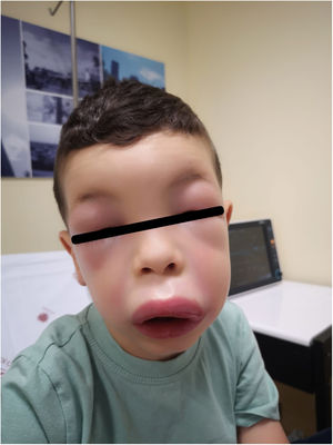 Initial presentation at the emergency department during the acute exacerbation.