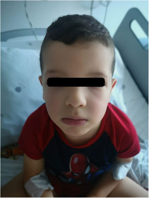 The patient at discharge, after the administration of IV C1 inhibitor, IV aminocaproic acid and subcutaneous icatibant.