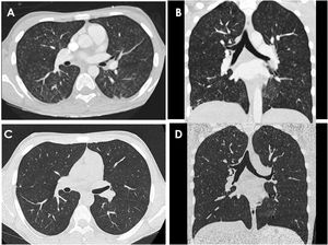 Comparison of axial and coronal views from the initial computed tomography scan (A and B) and images in the same planes (C and D) obtained 6 meses after treatment completion, showing the reported radiological improvement.