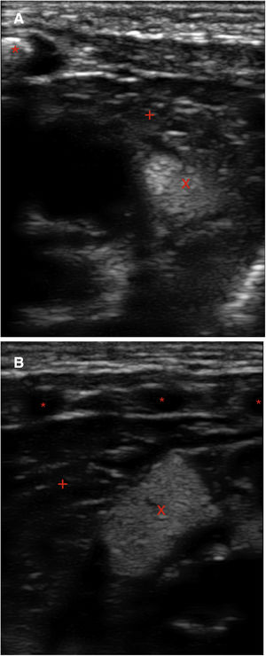 Point-of-care ultrasound of the chest. Linear probe. (A) Transverse plane at the level of the intermammary line. Visualization of sternum (*) and the masses (tubers) in the myocardium (homogeneous, hyperechoic, X). This contrasted with the decreased echogenicity of the myocardium (+). B) Left longitudinal plane: anterior arc of ribs (*), tubers (X), mediastinum (+). gr1.