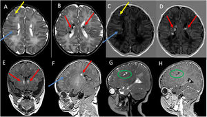 Magnetic resonance imaging of the head at 6 days post birth. Axial turbo spin echo (TSE) sequence T2-weighted images (A and B), axial T1 inversion recovery (T1IR) sequence image (C and D) Coronal T1-weigthed 3D image (E), sagittal T1-weighted 3D image (F), sagittal TSE T2-weighted image (G) and sagittal T1-weighted 3D following intravenous contrast administration (H). Visualization of cortical tubers that appeared hypointense on T2-weighted imaging and hyperintense on T1-weighted images (yellow arrows in A and C), radial migration lines in white matter (blue arrows in A, C and F), subependymal nodules (red arrows in B, D, E and F) and white matter cysts that appear hyperintense in T2-weighted images and without enhancement after contrast administration (green circle in G and H). The colour features of the figures can only be discerned in the digital version.