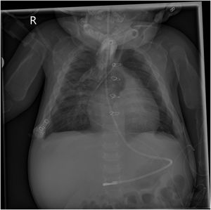 Plain radiograph at age 4 months evincing the progression of the bone abnormality, with hyperostosis and thickening of humeri, scapulae, clavicles and ribs.