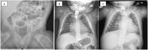 Plain radiographs taken after heart transplantation and at the end of treatment with prostaglandins. (A) At 3 months, (B) at 4 months, (C) at 6 months. They continue to show hyperostosis and bone thickening, without improvement or resolution after discontinuation of prostaglandin treatment. There seem to be no involvement of the pelvis or spine. The mandible was not affected either.