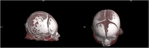Two 3D reconstructions showing the distribution of lacunar defects in the skullcap, lesions resulting from pronounced bone thinning of the inner table located bilaterally in the parasagittal region.