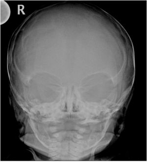 Skull radiograph with well-demarcated rounded areas of radiolucency in the skull.