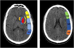 Alberta Stroke Programme Early CT Score (ASPECTS). It is used for the interpretation of a CT or MRI scan (diffusion sequence) in ischaemic stroke involving the anterior circulation. Two axial planes are analysed, the first one at the level of the thalamus and basal ganglia (plane A), and the second at the corona radiata level, in which the basal ganglia are not visible (plane B). The territory of the middle cerebral artery (MCA) in these 2 planes has been divided into 10 regions, each of which is assessed at 1 point. These regions are: L: lentiform nucleus (putamen); C: caudate; IC: internal capsule; I: insular ribbon; M1: Anterior MCA cortex; M2: MCA cortex lateral to insular ribbon; M3: posterior MCA cortex; M4, M5, M6: anterior, lateral and posterior territory of the MCA, approximately 2 cm superior to M1, M2 and M3, respectively. Based on this analysis, one point is deducted from the initial 10 for each region exhibiting early signs of ischaemia (hypodensity or local mass effect). Scores of 7 points or less are associated with poor functional recovery and high morbidity and mortality, with a higher risk of intraparenchymal haemorrhage. A score of 10 corresponds to a normal CT scan.