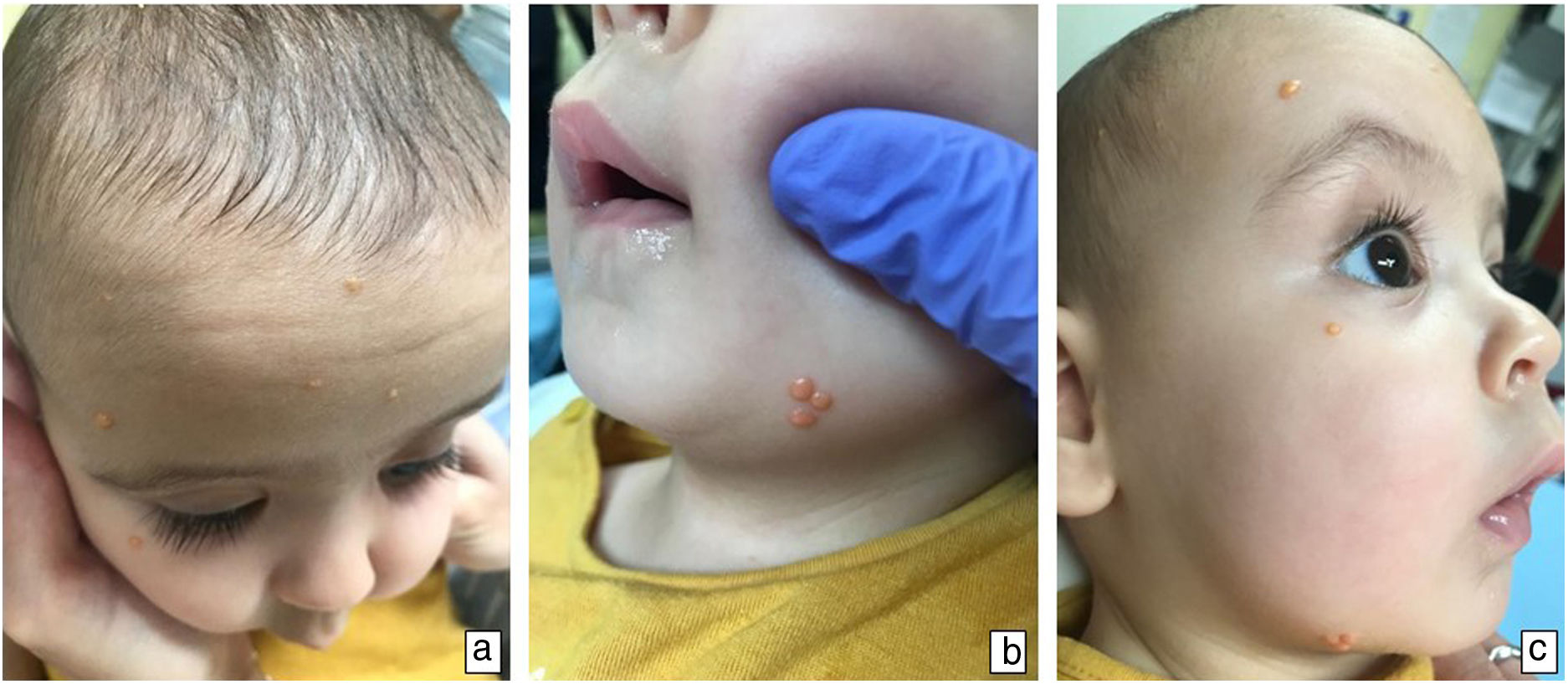 Yellowish Rash Yellow papules on the face and scalp | Anales de Pediatría