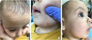 a–c) Cutaneous presentation at the time of the initial appointment in the Department of Dermatology, with multiple yellow papules located on the scalp, forehead, cheeks, and jaw.
