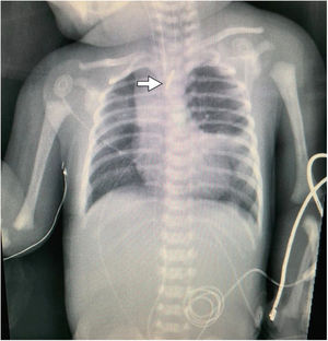 Orogastric tube in the oesophageal diverticulum at the level of T2 (arrow). Notice the absence of air in the abdominal cavity.