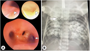 (A) Bronchoscopy images showing a subtle mucosal fold in the middle third and posterior wall of the trachea concealing a diverticulum measuring at least 1cm in diameter (arrowhead) and image showing tracheal trifurcation with an ectopic opening in the right lateral wall of the trachea (arrow). (B) The injection of contrast material evinced a tracheal bronchus that ended in the right upper lobe (arrow), ruling out tracheo-oesophageal fistula.