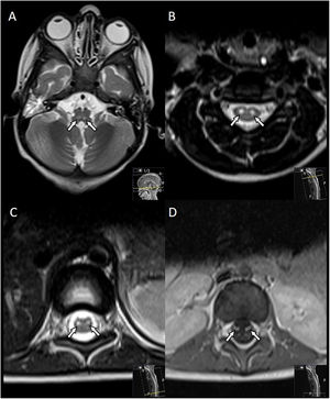 Medullomyeloradiculitis, axial view. T2-weighted images showed 2 symmetric hyperintense foci in the posterior medulla oblongata (arrows in A), confirmed selective involvement of anterior horns of the spinal cord, shown at the cervical (arrows in B) and conus medullaris (arrows in C) levels, with enhancement of the ventral roots of the cauda equina in the post-contrast axial T1-weighted image (arrows in D).