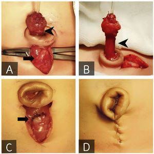 Infraumbilical incision and dissection of the entire length of the urachus (A, arrowhead) extending to the bladder dome (A, arrow). Excision of the patent portion of the urachus (B, arrowhead), three-layer repair of the bladder dome (C, arrow) and cosmetic outcome of the umbilicoplasty (D).