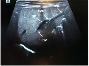 Image obtained during ultrasound-guided umbilical vein catheterization. The umbilical catheter can be traversing the portal sinus to enter the ductus venosus.