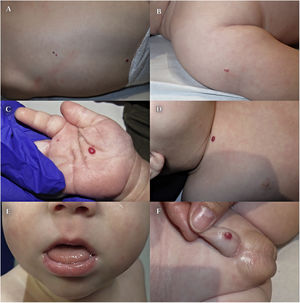A–D and F) Clinical image. Red papules with a vascular appearance measuring 2–6 mm located in the back, right shoulder, right palm, right clavicle and penis. E) Clinical image.