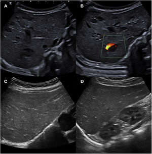 A and B) Abdominal ultrasound scan with visualization of 10 to 15 hypoechogenic space-occupying lesions compatible with hepatic haemangioma. A Doppler signal can be seen in image B. C and D) Abdominal ultrasound scan at 4 months of treatment, in which the hepatic haemangiomas can no longer be seen.