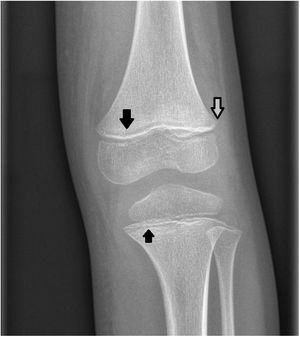 Plain radiograph of the left knee. Small bilateral metaphyseal spurs (green arrow), widening of the physeal lines, clear metaphyseal band (black arrow) in the distal femur and proximal tibia in the Trummerfel zone and white line of Frankel.