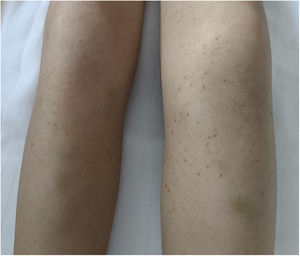 Petechiae and perifollicular haemorrhages in the lower extremities associated with ecchymosis.
