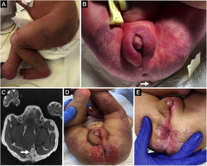 Segmental infantile haemangioma in the perineal and lumbosacral regions extending to the lower extremities (A) and lumbosacral skin tag (B, arrow). Magnetic resonance image evincing the presence of lipomyeloschisis (C, arrow). Ulcerated perineal haemangioma (D) that responded well to treatment with propranolol (E).