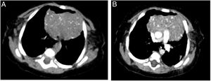 Axial computed tomography scan of the chest without contrast (A) and with contrast (B) evincing thymus hypertrophy. There were multiple punctate calcifications in the thymus, characteristic of Langerhans cell histiocytosis in this organ.