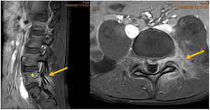 Magnetic resonance image (post-contrast T1-weighted fat-saturated sagittal and axial views). Marked enhancement of the bone marrow of the pedicle and left articular processes of L5 (star) and the periarticular soft tissues (arrows), with an inflammatory appearance, probably secondary to trauma.
