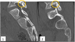 Computed tomography image (bone kernel sagittal reconstruction at the level of the right (1) and left (2) pars interarticularis of L5). Bilateral spondylolysis, with fracture lines at the level of the pars interarticular in each side (circles), with poorer definition in the left side, accompanied by periosteal thickening (arrow).