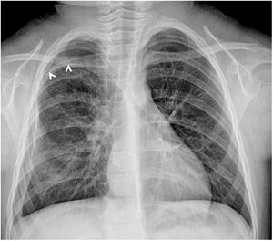 Anterior–posterior chest radiograph showing an abnormally oriented rib in the right side (arrowheads).