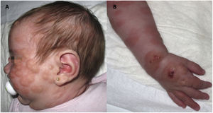 (A) Girl aged 1 month with diffuse cutaneous mastocytosis; (B) diffuse infiltrated plaques with a peau d’orange appearance, focal blisters and rough thickening of skin.